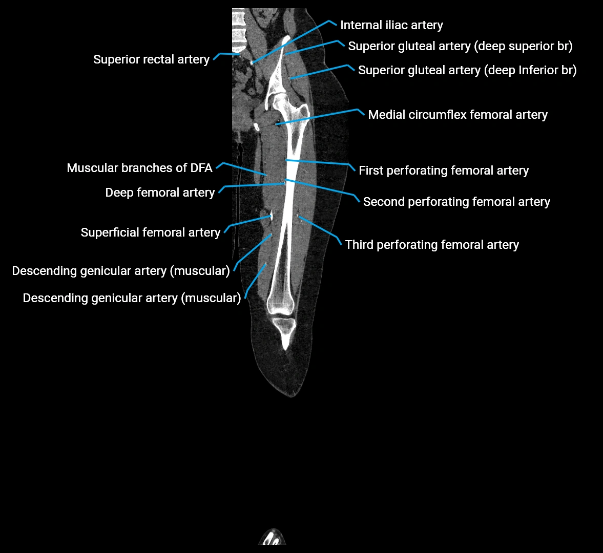 CTA lower limb coronal cross sectional anatomy labelled image _38 (2).webp